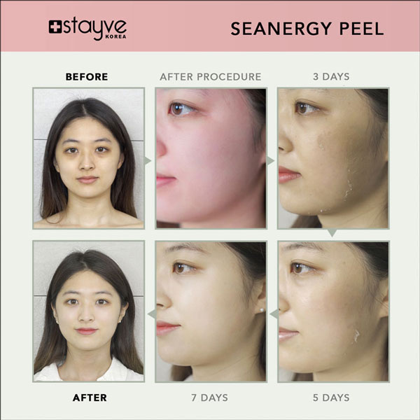 professional-korean-skincare-peel-salon