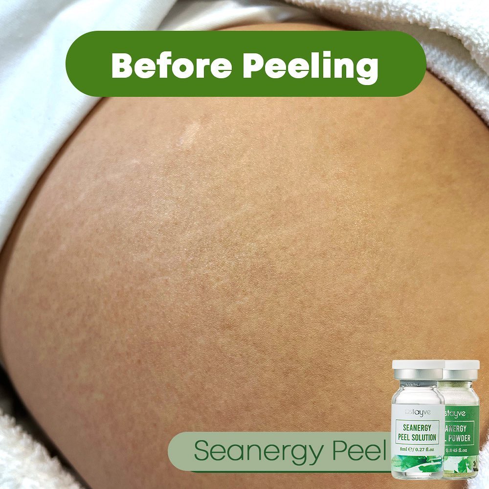 seanergy_peel_2