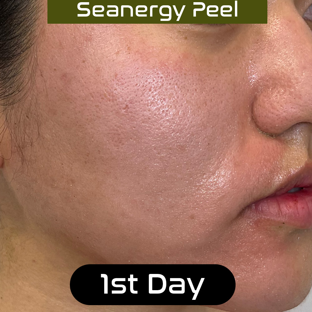 seanergy_peel_skin_beauty_tips