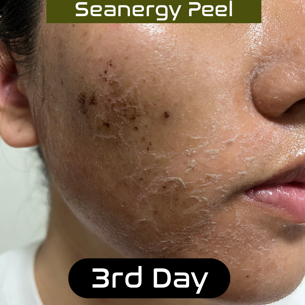 seanergy_peel_skin_beauty_tips_1