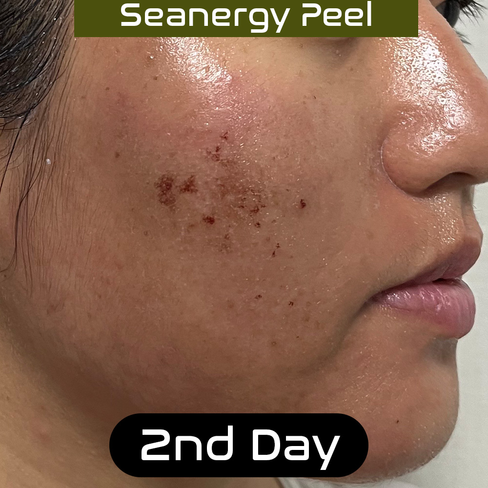 seanergy_peel_skin_beauty_tips_3