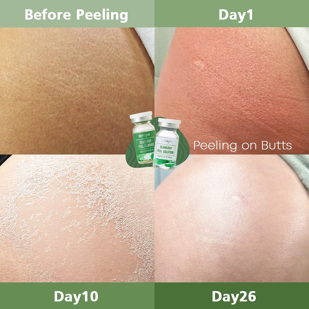 skin_peeling_solution