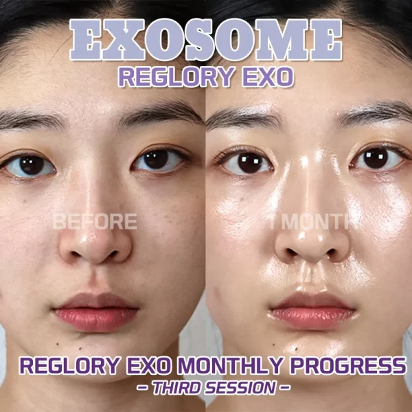 Reglory EXO microneedling